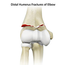 Distal Humerus Fractures of the Elbow